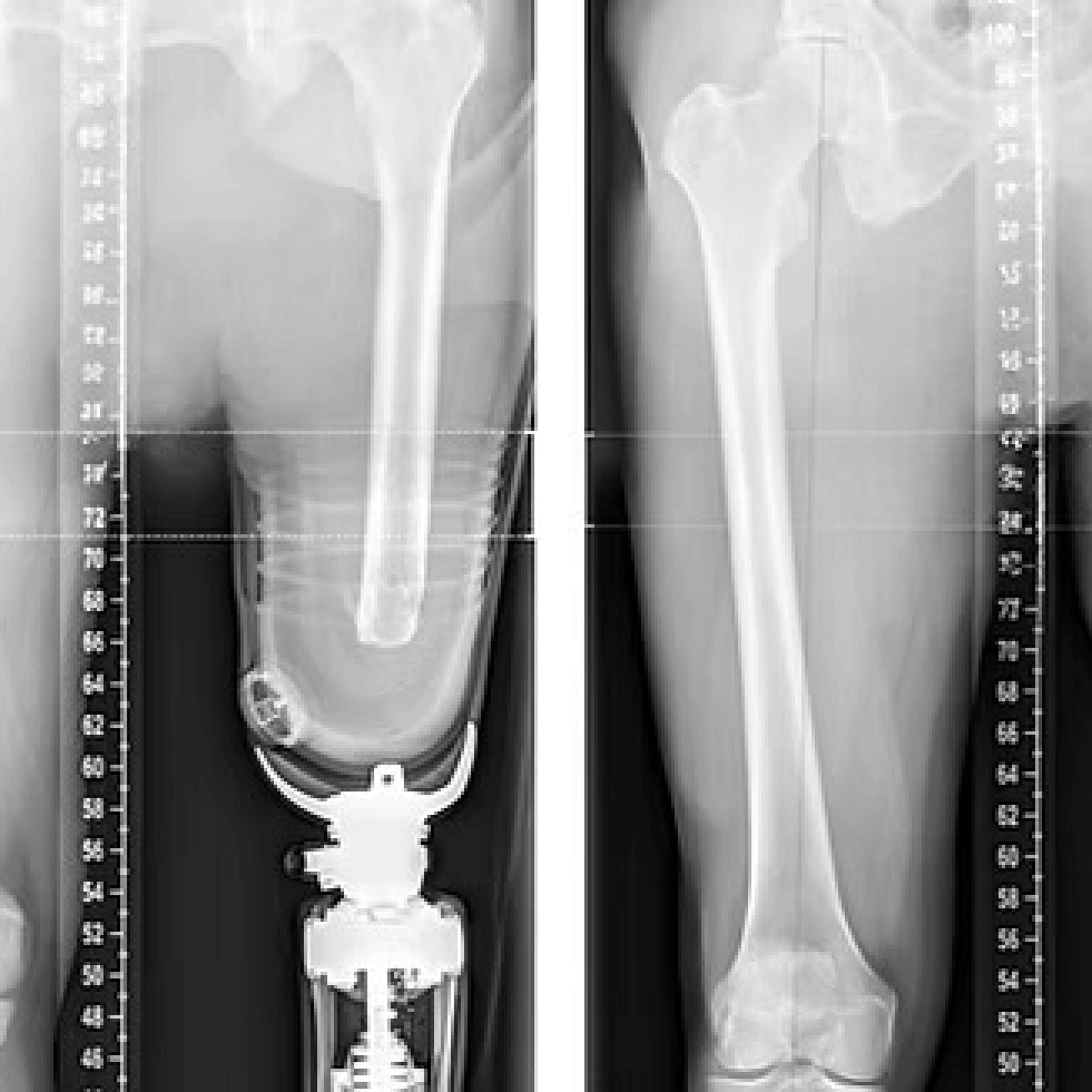 Pre and Post XRay